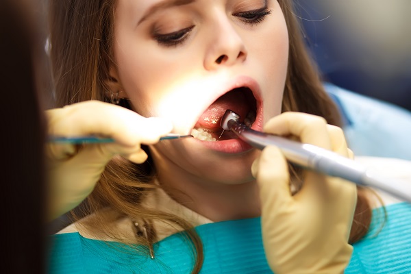 Reasons To Choose Composite Fillings
