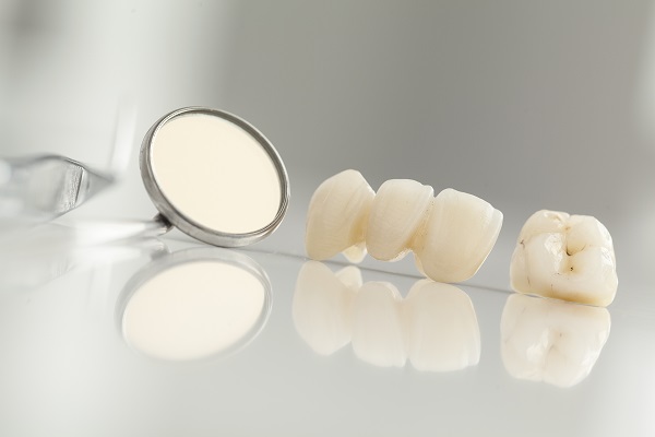 When Would A Dentist Recommend Dental Bridges?