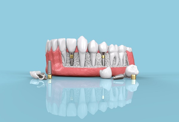 Dental Implants Irvine, CA