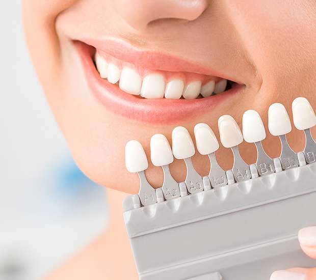 Irvine Dental Veneers and Dental Laminates