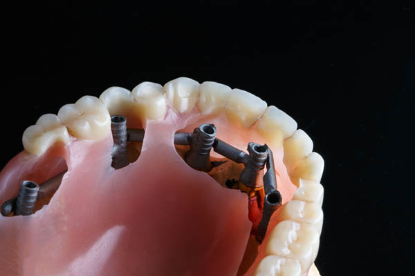 Implant Supported Dentures Irvine, CA