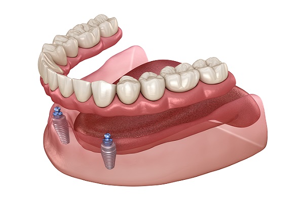 Implant Supported Dentures Irvine, CA